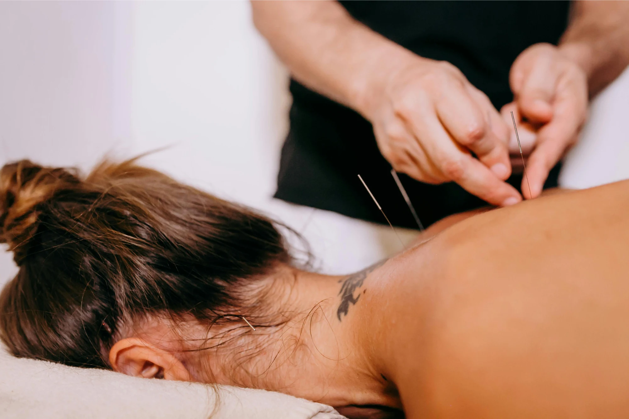 What Is Dry Needling? A Modern Approach to Pain Relief & Performance at Aureum Physio