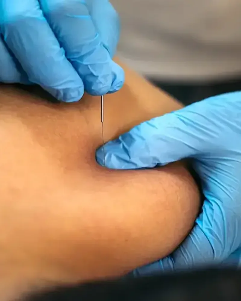 Gloved hands inserting a fine needle into a muscle trigger point