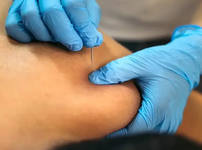 Fine needle being placed into a muscle trigger point